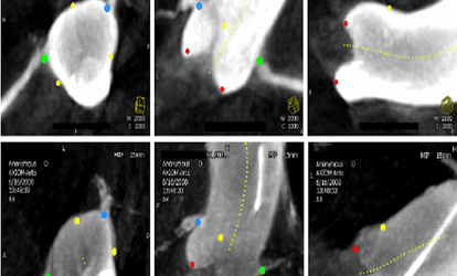 The aortic valve landmark detection results on two example datasets with red dots for the hinge points, yellow for the commissure points, blue for the left coronary ostium, and green for the right coronary ostium. Each row shows three orthogonal cuts of a volume.